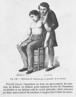 Réduction de luxation de l'épaule par le procédé de la cravate - Aide-mémoire de médecine, de chirur [...]