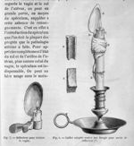 Réflecteur pour éclairer le vagin; cuillère adaptée contre une bougie pour servir de réflecteur - Tr [...]