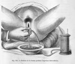 Position de la femme pendant l'injection intra-utérine - Traité pratique des maladies des femmes hor [...]