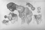 Grossesse extra-utérine - Iconographie pathologique, ou collection des faits rares et intéressants