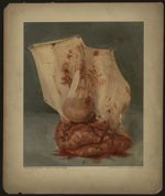 Poche amnio-chiarale. Placenta de Depagne. Accouchement le 26 juin 1893