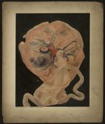 Placenta de Barbarin. Thrombose veine ombilicale. Accouchement le 5 mai 1893