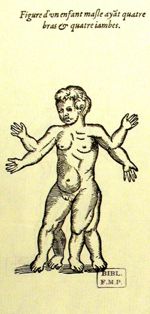 Enfant masle ayant quatre bras & quatre iambes - Les oeuvres d'Ambroise Paré... divisées en vingt hu [...]