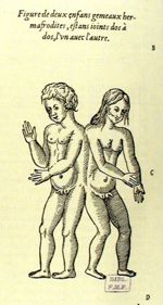 Deux enfans gemeaux hermafrodites, estant ioints dos à dos - Les oeuvres d'Ambroise Paré... divisées [...]