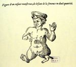 Enfant monstrueux, de défaut de la semence en deüe quantité - Les oeuvres d'Ambroise Paré... divisée [...]