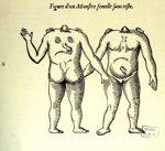Monstre femelle sans teste - Les oeuvres d'Ambroise Paré... divisées en vingt huit livres