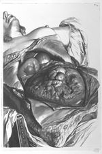 Mulieris ultra septem menses gravidae apertum abdomen - Anatomia humani corporis