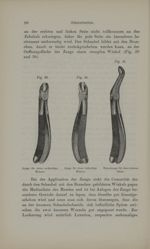 [Fig.29. Pince pour les molaires supérieures droites / Fig.30. Pince pour les molaires supérieures g [...]