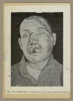 [Portrait d'un homme de face présentant un traumatisme de la face avec importante perte de substance [...]