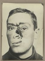 [Portrait de face avec traumatisme du nez, fosses nasales béantes. Avant pose de prothèse nasale.]