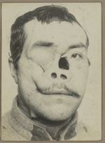 [Portrait de face montrant un traumatisme médio-facial avec ouverture béante sur les fosses nasales  [...]