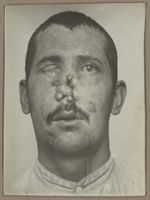 [Portrait de face préopératoire montrant une lésion du nez avec perte de substance et la perte de l' [...]