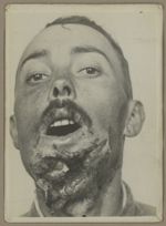 [Portrait de face préopératoire montrant un traumatisme du maxillaire inférieur avec perte de substa [...]