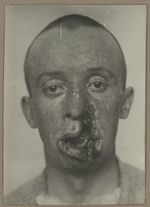 [Portrait de face préopératoire montrant un traumatisme des maxillaires avec perte de substance s'ét [...]