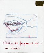 [Schéma des maxillaires, inférieur et supérieur, avec appareillage pour réduction de fracture déplac [...]