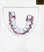 [Schéma d'appareillage orthodontique.]