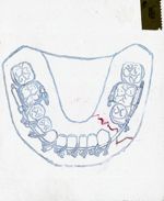 [Schéma d'appareillage orthodontique.]