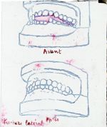 [Schéma illustrant les résultats d'une réduction de fracture du maxillaire inférieur.] 