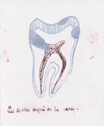 [Schéma pédagogique des stades de la carie dentaire.]