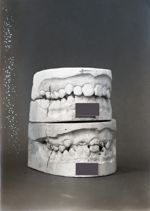 [Deux paires de moulages dentaires superposés montrant l'évolution de l'occlusion après traitement o [...]