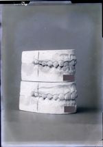 [Deux paires de moulages dentaires superposés montrant l'évolution de l'occlusion après traitement d [...]