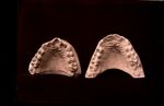 [Deux moulages dentaires du maxillaire supérieur, montrant l'évolution après traitement orthodontiqu [...]