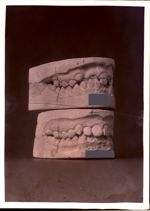 [Deux paires de moulages dentaires superposés montrant l'évolution de l'occlusion après traitement o [...]