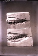 [Deux paires de moulages dentaires superposés montrant l'évolution après traitement orthodontique d' [...]