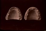 [Moulages dentaires, maxillaire supérieur, montrant l'évolution après traitement orthodontique de ma [...]
