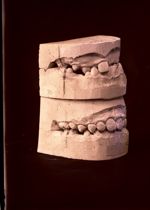 [Deux paires de moulages dentaires superposés montrant l'évolution après traitement orthodontique de [...]