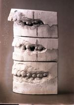 [Trois paires de moulages dentaires superposés montrant l'évolution après traitement orthodontique d [...]