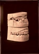[Deux paires de moulages dentaires superposés montrant l'évolution après traitement orthodontique de [...]
