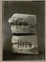 [Photographie de deux moulages dentaires du maxillaire supérieur montrant l'évolution après correcti [...]