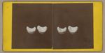 [Deux clichés collés sur carton. Chacun montre deux moulages dentaires du maxillaire supérieur prése [...]