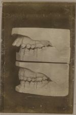 [Deux paires de moulages dentaires montrant l'évolution d'un overjet après traitement orthodontique. [...]