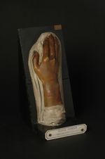 Érythème papuleux (rhumatismal) du poignet et du dos de la main