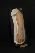 Syphilide papulo-tuberculeuse de l'avant-bras gauche