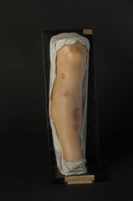 Syphilide tuberculeuse plate de la jambe