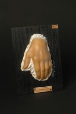 Rhumatisme blennorrhagique ; déformation des doigts, atrophie musculaire ; main gauche