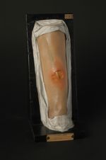 Gommes syphilitiques ulcérées de la jambe
