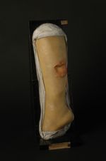 Gomme syphilitique en nappe de la jambe