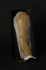 Syphilide tuberculo-crustacée du bras droit ; forme circinée