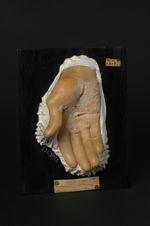 Kératose palmaire d'origine syphilitique, lésion simulant l'eczéma corné ; main droite