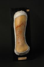 Lésions gommeuses syphilitiques ulcérées de la jambe