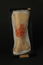 Gomme syphilitique en nappe de la jambe ; période d'ulcération ; phagédénisme tertiaire