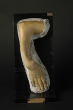 Phagédénisme syphilitique tertiaire de l'avant-bras ; lésions osseuses, nécrose des os (V. le n° 62, [...]