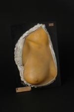 Syphilide papulo-squameuse du thorax ; forme circinée