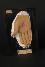Dermatite traumatique syphiloïde de la paume de la main droite