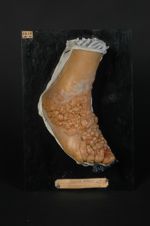 Éléphantiasis du pied (Inv. 1922). Pachydermie végétante (Inv. 1889). Éruption papilliforme, consécu [...]