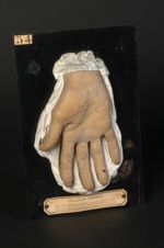 Syphilide psoriasiforme de la paume de la main (Inv. 1889). Homme âgé de 19 ans